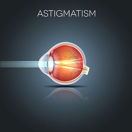 Chart Illustrating how astigmatism affects light entering an eye