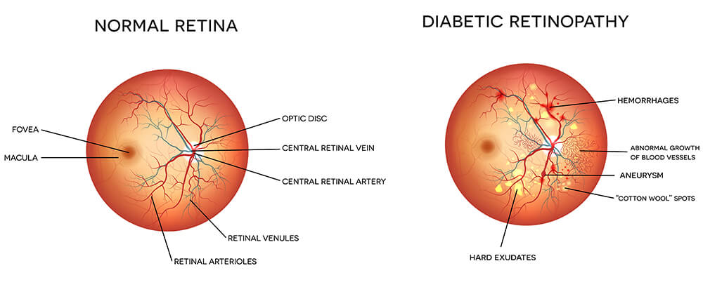 Chart illustrating a normal retina vs one experiencing diabetic retinopathy